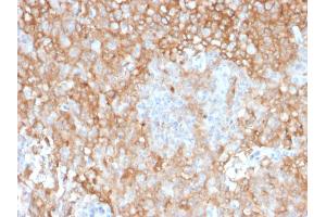 Formalin-fixed, paraffin-embedded human Lung Tumor stained with HLA-DR Mouse Monoclonal Antibody (TAL 1B5). (HLA-DR Antikörper)