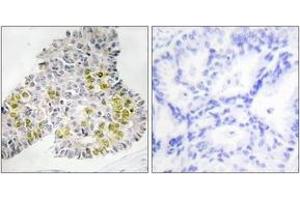 Immunohistochemistry analysis of paraffin-embedded human lung carcinoma tissue, using LKB1 (Ab-428) Antibody. (LKB1 Antikörper  (AA 384-433))