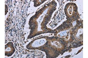 The image on the left is immunohistochemistry of paraffin-embedded Human colon cancer tissue using ABIN7129926(ITGAE Antibody) at dilution 1/50, on the right is treated with fusion protein.
