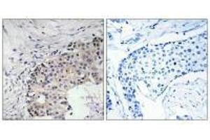 Immunohistochemistry analysis of paraffin-embedded human breast carcinoma tissue using SCARF2 antibody.