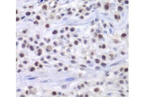 Immunohistochemistry of paraffin-embedded Mouse osteosarcoma using HAT1 Polyclonal Antibody at dilution of 1:200 (40x lens). (HAT1 Antikörper)
