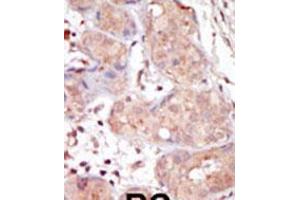 Formalin-fixed and paraffin-embedded human cancer tissue reacted with the primary antibody, which was peroxidase-conjugated to the secondary antibody, followed by DAB staining. (MAK Antikörper  (C-Term))