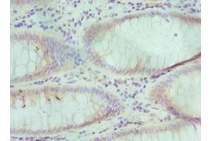 Immunohistochemistry of paraffin-embedded human colon cancer using ABIN7151592 at dilution of 1:100 (TCEB3 Antikörper  (AA 679-798))
