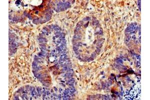 Immunohistochemistry of paraffin-embedded human ovarian cancer using ABIN7147287 at dilution of 1:100 (CDC6 Antikörper  (AA 1-141))