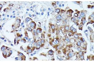 Immunohistochemistry of paraffin-embedded Human liver cancer using PDE3A Polyclonal Antibody at dilution of 1:100 (40x lens). (PDE3A Antikörper)