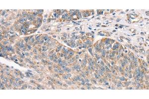 Immunohistochemistry of paraffin-embedded Human ovarian cancer using DECR1 Polyclonal Antibody at dilution of 1:50 (DECR1 Antikörper)