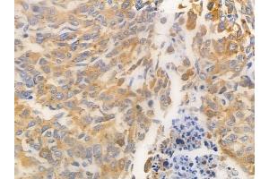 ABIN6263991 and ABIN6269401 at 1/100 staining human lung squamous cell carcinoma by IHC-P. (RPS6KB2 Antikörper  (C-Term))