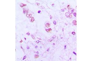 Immunohistochemical analysis of ATF3 staining in human lung cancer formalin fixed paraffin embedded tissue section.