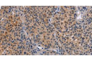 Immunohistochemistry of paraffin-embedded Human liver cancer tissue using MAP3K13 Polyclonal Antibody at dilution 1:40 (MAP3K13 Antikörper)