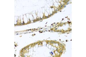 Immunohistochemistry of paraffin-embedded human colon carcinoma using PMPCB antibody at dilution of 1:100 (x40 lens). (PMPCB Antikörper)