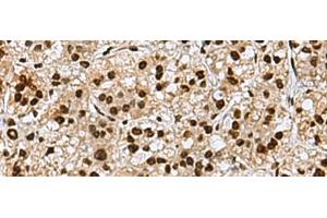 Immunohistochemistry of paraffin-embedded Human liver cancer tissue using MYEF2 Polyclonal Antibody at dilution of 1:70(x200) (MYEF2 Antikörper)