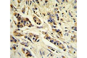 IHC analysis of FFPE human breast carcinoma stained with IL-10 antibody
