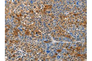The image on the left is immunohistochemistry of paraffin-embedded Human liver cancer tissue using ABIN7191027(HTRA3 Antibody) at dilution 1/45, on the right is treated with synthetic peptide. (HTRA3 Antikörper)
