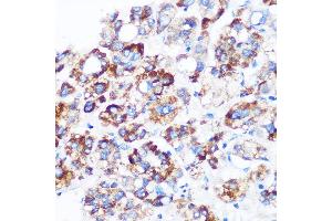 Immunohistochemistry of paraffin-embedded Human liver cancer using C9orf114 Rabbit pAb (ABIN7266390) at dilution of 1:100 (40x lens).