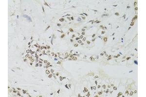 Immunohistochemistry of paraffin-embedded human gastric cancer using PPP4C antibody (ABIN5971135) at dilution of 1/100 (40x lens). (PPP4C Antikörper)