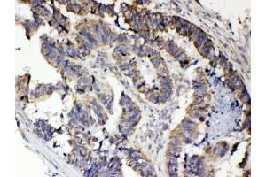 IHC testing of FFPE human intestinal cancer tissue with RANK antibody at 1ug/ml. (TNFRSF11A Antikörper  (AA 235-262))