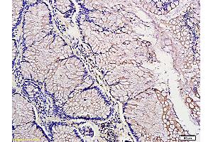 Formalin-fixed and paraffin embedded: human colon tubular adenocarcinoma labeled with Anti-PDGF-A Polyclonal Antibody (ABIN726155), Unconjugated at 1:300, followed by conjugation to the secondary antibody and DAB staining (PDGFA Antikörper  (AA 125-170))