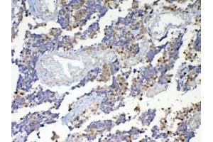IHC testing of FFPE human lung cancer tissue with Dnmt1 antibody at 1ug/ml. (DNMT1 Antikörper)