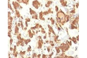 Formalin-fixed, paraffin-embedded human thyroid carcinoma stained with Cytokeratin 18 antibody.