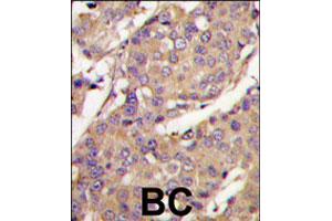 Formalin-fixed and paraffin-embedded human breast carcinoma tissue reacted with UBE2L6 polyclonal antibody  , which was peroxidase-conjugated to the secondary antibody, followed by DAB staining. (UBE2L6 Antikörper  (C-Term))