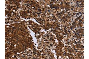 The image on the left is immunohistochemistry of paraffin-embedded Human liver cancer tissue using ABIN7190664(FMN2 Antibody) at dilution 1/30, on the right is treated with synthetic peptide.