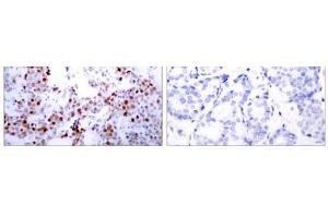 Immunohistochemical analysis of paraffin-embedded human breast carcinoma tissue using ATF-2 (Ab-62 or 44) antibody (E021029). (ATF2 Antikörper)