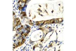 Immunohistochemistry of paraffin-embedded human gastric cancer using SNCA antibody at dilution of 1:100 (x40 lens). (SNCA Antikörper)