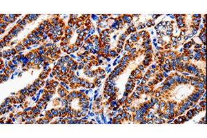 Immunohistochemistry of paraffin-embedded Human thyroid cancer tissue using COX19 Polyclonal Antibody at dilution 1:50 (COX19 Antikörper)