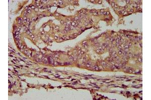 IHC image of ABIN7159857 diluted at 1:200 and staining in paraffin-embedded human endometrial cancer performed on a Leica BondTM system. (ENOSF1 Antikörper  (AA 171-286))