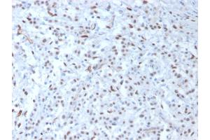 Formalin-fixed, paraffin-embedded human Mesothelioma stained with Wilm's Tumor Mouse Monoclonal Antibody (WT1/857). (WT1 Antikörper)