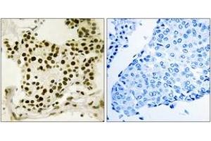 Immunohistochemistry analysis of paraffin-embedded human breast carcinoma, using UBF (Phospho-Ser484) Antibody. (UBTF Antikörper  (pSer484))
