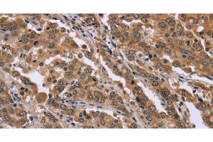 Immunohistochemistry of paraffin-embedded Human liver cancer tissue using FAM3B Polyclonal Antibody at dilution 1:40 (FAM3B Antikörper)