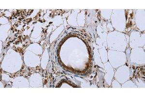 Immunohistochemistry of paraffin-embedded Human breast cancer using FBP1 Polyclonal Antibody at dilution of 1:40 (FBP1 Antikörper)