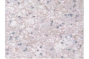 DAB staining on IHC-P;Samples:Human Glioma Tissue) (ORM1 Antikörper  (AA 19-201))