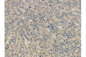 ABIN7094177 and ABIN7098222 at 1/100 staining human hepatocellular carcinoma by IHC-P.