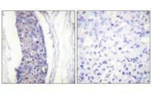 Immunohistochemistry analysis of paraffin-embedded human breast carcinoma tissue using Tubulin α antibody. (TUBA1A Antikörper  (C-Term))