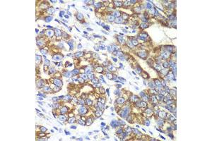 Immunohistochemistry of paraffin-embedded human gastric cancer using RALB antibody (ABIN6293713) at dilution of 1:100 (40x lens). (RALB Antikörper)