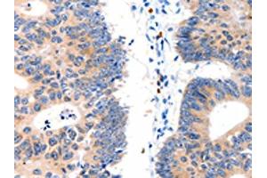 The image on the left is immunohistochemistry of paraffin-embedded Human colon cancer tissue using ABIN7130064(LAT2 Antibody) at dilution 1/15, on the right is treated with fusion protein. (LAT2 Antikörper)