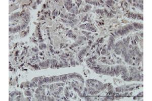 Immunoperoxidase of monoclonal antibody to FOXO3A on formalin-fixed paraffin-embedded human colon adenocarcinoma. (FOXO3 Antikörper  (AA 361-460))