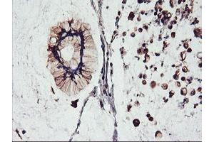 Immunohistochemical staining of paraffin-embedded Adenocarcinoma of Human colon tissue using anti-FBXO21 mouse monoclonal antibody. (FBXO21 Antikörper)