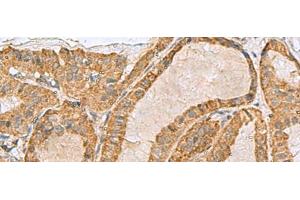 Immunohistochemistry of paraffin-embedded Human thyroid cancer tissue using PREPL Polyclonal Antibody at dilution of 1:55(x200)