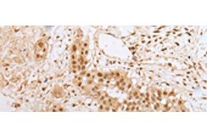Immunohistochemistry of paraffin-embedded Human colorectal cancer tissue using ZNF22 Polyclonal Antibody at dilution of 1:25(x200) (Zinc Finger Protein 22 Antikörper)