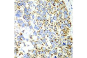 Immunohistochemistry of paraffin-embedded human esophageal cancer using CHIA antibody (ABIN5971776) at dilution of 1/100 (40x lens). (CHIA Antikörper)