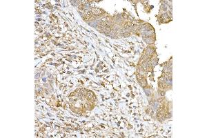 Immunohistochemistry of paraffin-embedded human colon carcinoma using SOCS1 Rabbit pAb (ABIN6128737, ABIN6148263, ABIN6148266 and ABIN6223700) at dilution of 1:250 (40x lens).