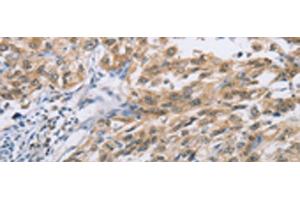 Immunohistochemistry of paraffin-embedded Human esophagus cancer tissue using ZIC5 Polyclonal Antibody at dilution of 1:100(x200) (ZIC5 Antikörper)