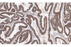 IHC-P Image Immunohistochemical analysis of paraffin-embedded human ovarian cancer, using ACADM, antibody at 1:100 dilution. (Medium-Chain Specific Acyl-CoA Dehydrogenase, Mitochondrial (C-Term) Antikörper)
