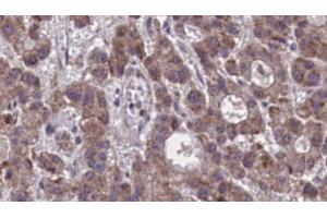 ABIN6273877 at 1/100 staining Human liver cancer tissue by IHC-P. (Prostaglandin D2 Receptor 2 (PTGDR2) (Internal Region) Antikörper)