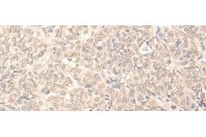 Immunohistochemistry of paraffin-embedded Human ovarian cancer tissue using RUVBL2 Polyclonal Antibody at dilution of 1:25(x200) (RUVBL2 Antikörper)
