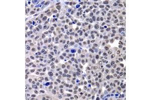 Immunohistochemistry of paraffin-embedded mouse cancer using H2AFY antibody (ABIN2562982) at dilution of 1:100 (40x lens). (H2AFY Antikörper)