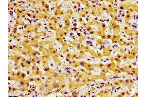 Immunohistochemistry of paraffin-embedded human liver cancer using ABIN7148001 at dilution of 1:100 (F13A1 Antikörper  (AA 380-520))